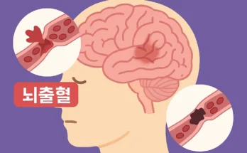 뇌출혈과 뇌경색 증상 및 예방법 총정리